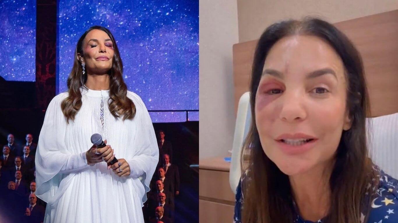 Ivete Sangalo recebe alta hospitalar após cirurgia para corrigir o maxilar: “Estou ótima”