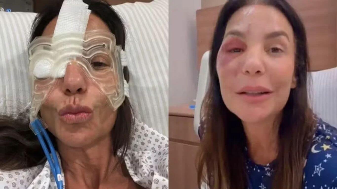 Ivete Sangalo surge de máscara de gelo enquanto se recupera de cirurgia no rosto